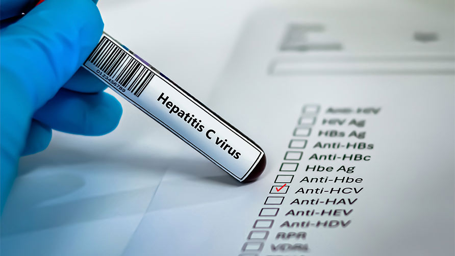 hepatitis c