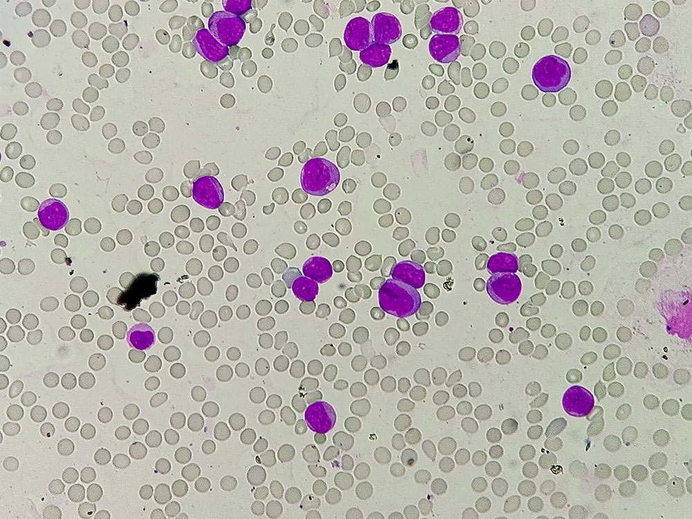 leucemia mieloide aguda